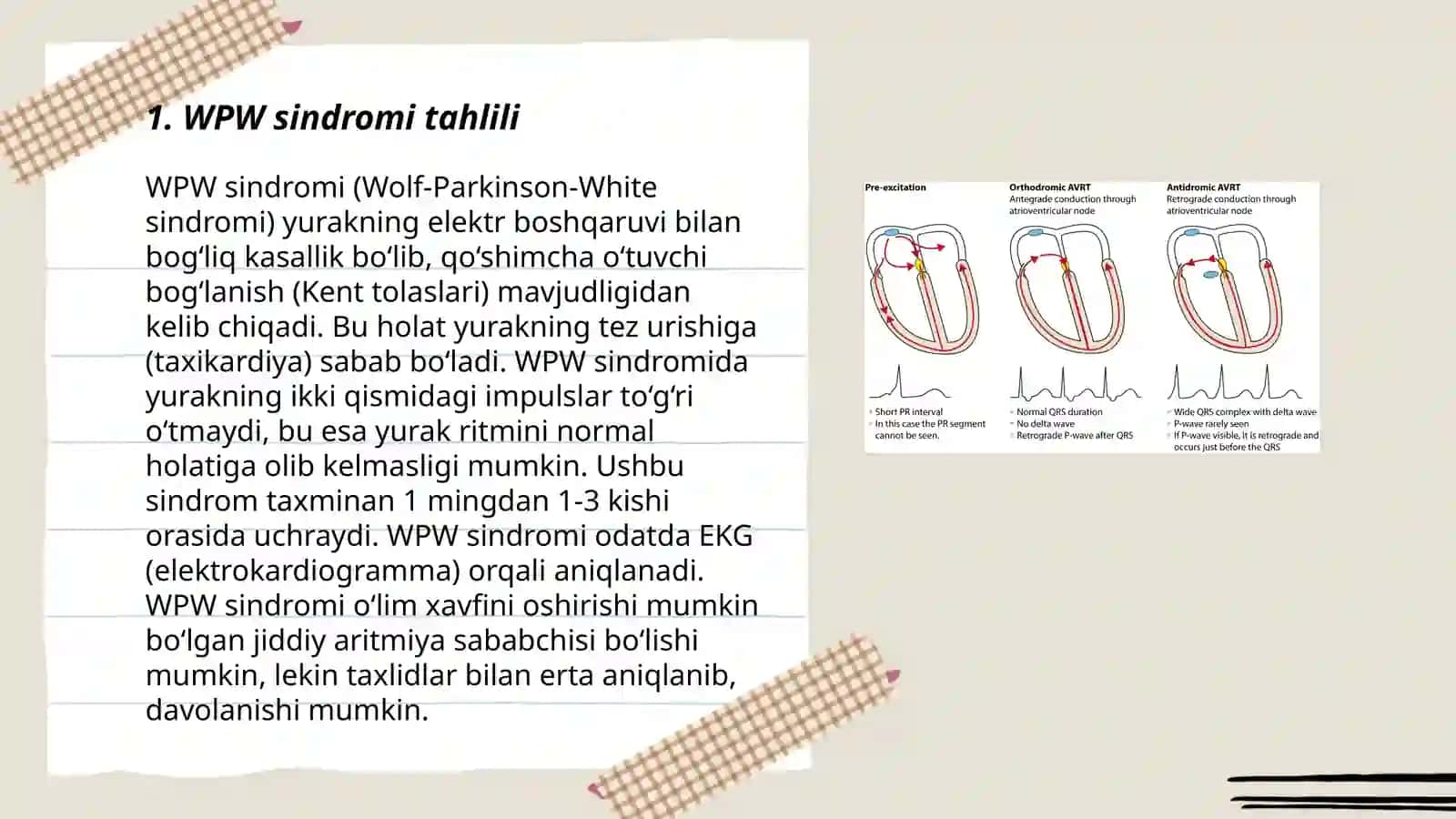 WPW sindromi tahlili 3