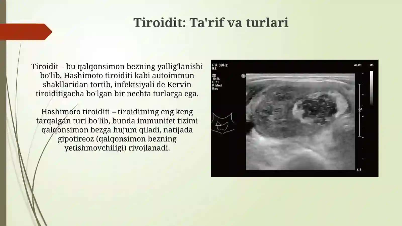 Tireoiditlar qalqonsimon bez yallig'lanishi 3