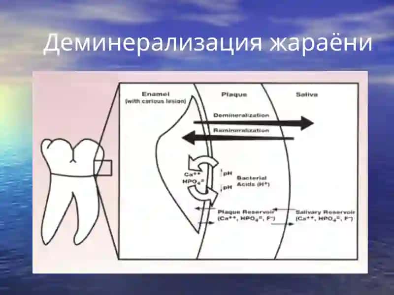 Болаларда тишлар кариеси. Этиологияси, патогенези, таснифи. Болалар ёшида кариес касаллиги кечишининг ўзига хос хусусиятлари ва даволаш йўллари 3