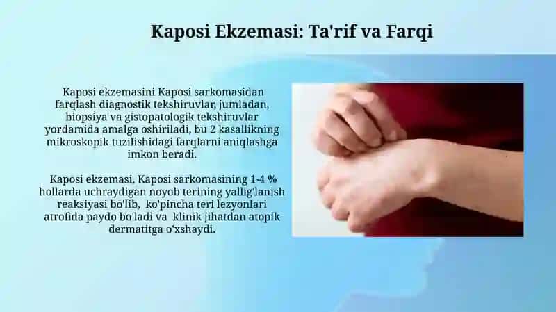 Kaposi Sarkomasi va Ekzemasi 3