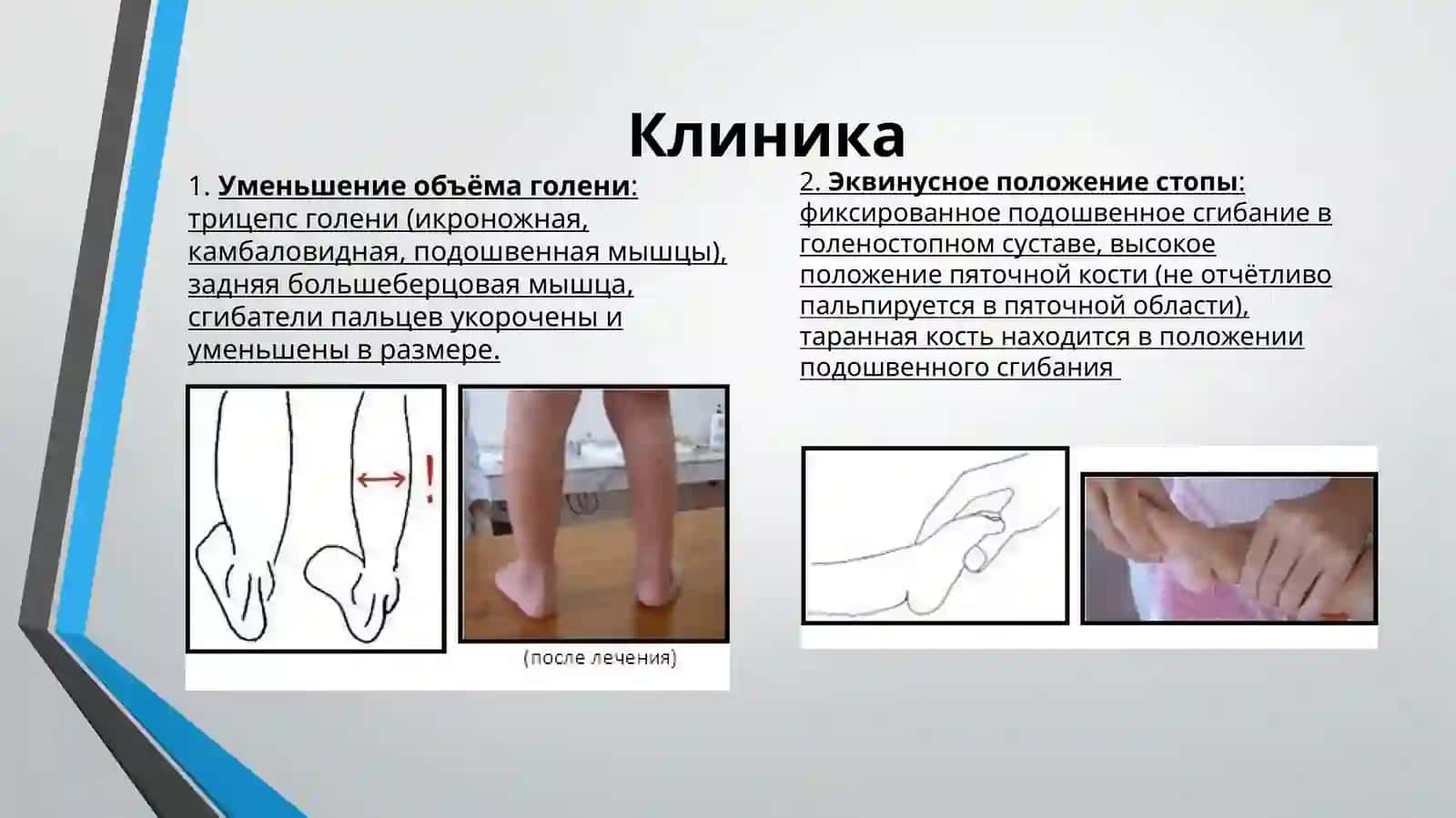 Врожденная косолапость у детей 3