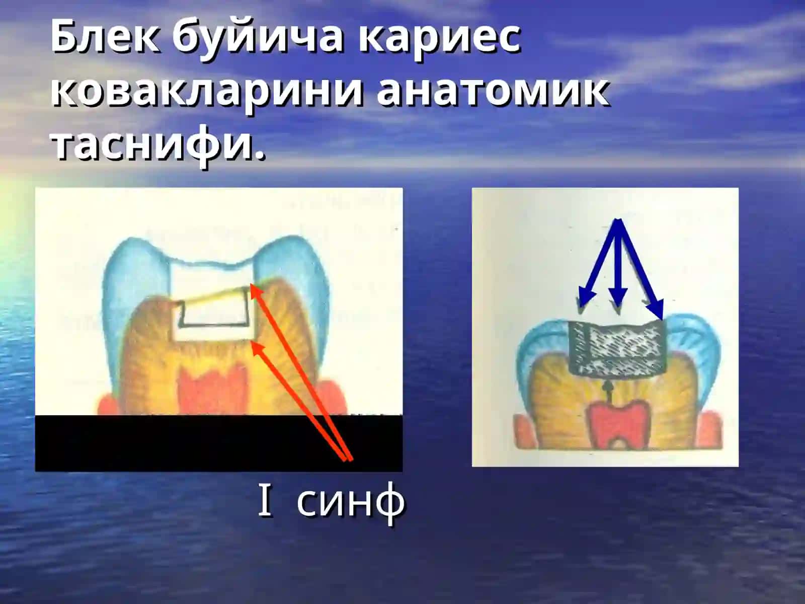Кариес ковакларини чархлаш босқичлари ва услублари 3