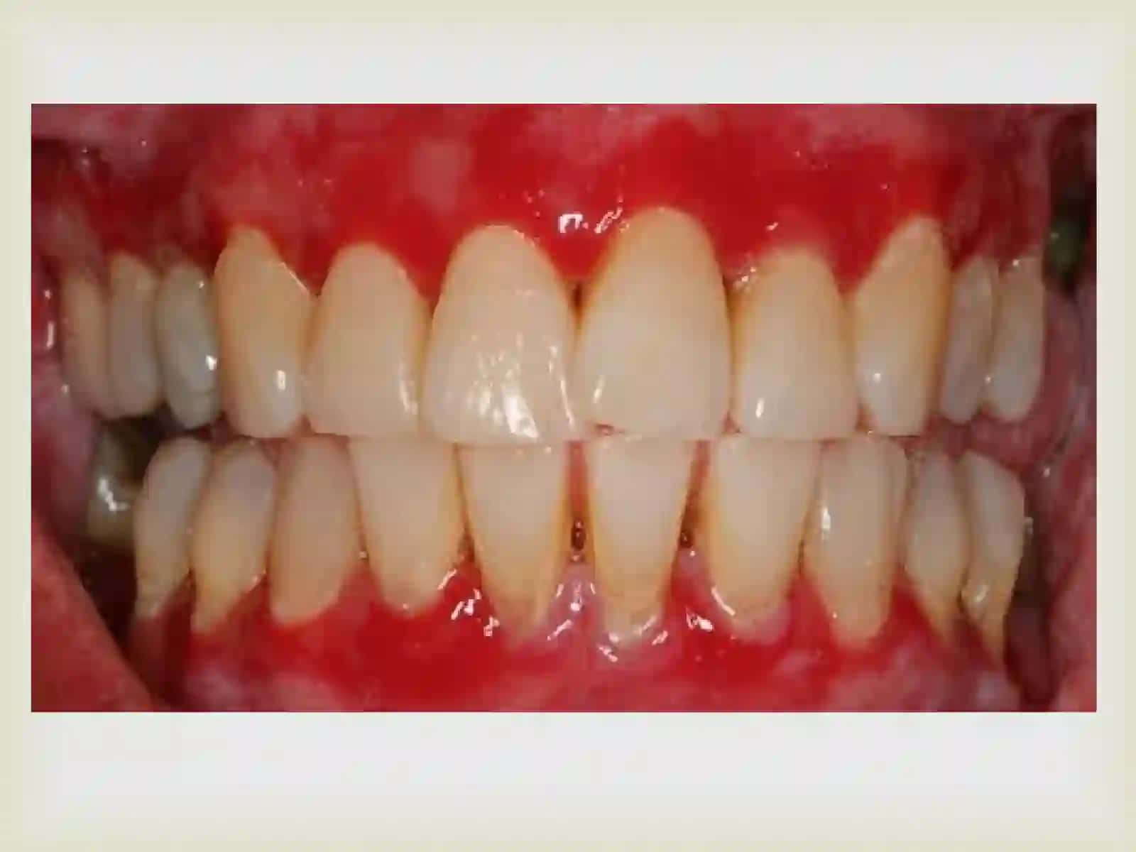 Deskvamativ gingivitlarni klinikasi,diagnostikasi qiyosiy tashxisi, davolash, profilaktikasi. Kasallik tarixini yozish. 3