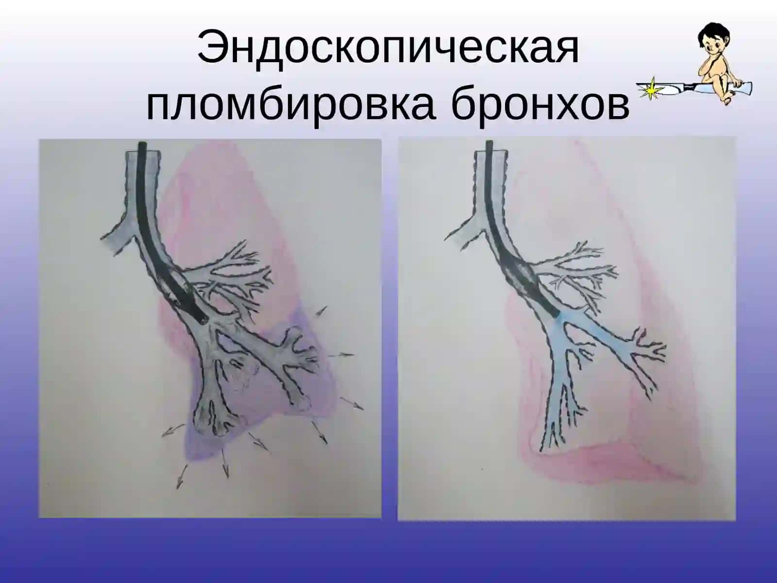 Болаларда сурункали йирингли ўпка ва плевра касалликлари. Диагностика ва дифференсиал диагностикаси. Врач педиатр тактикаси 3