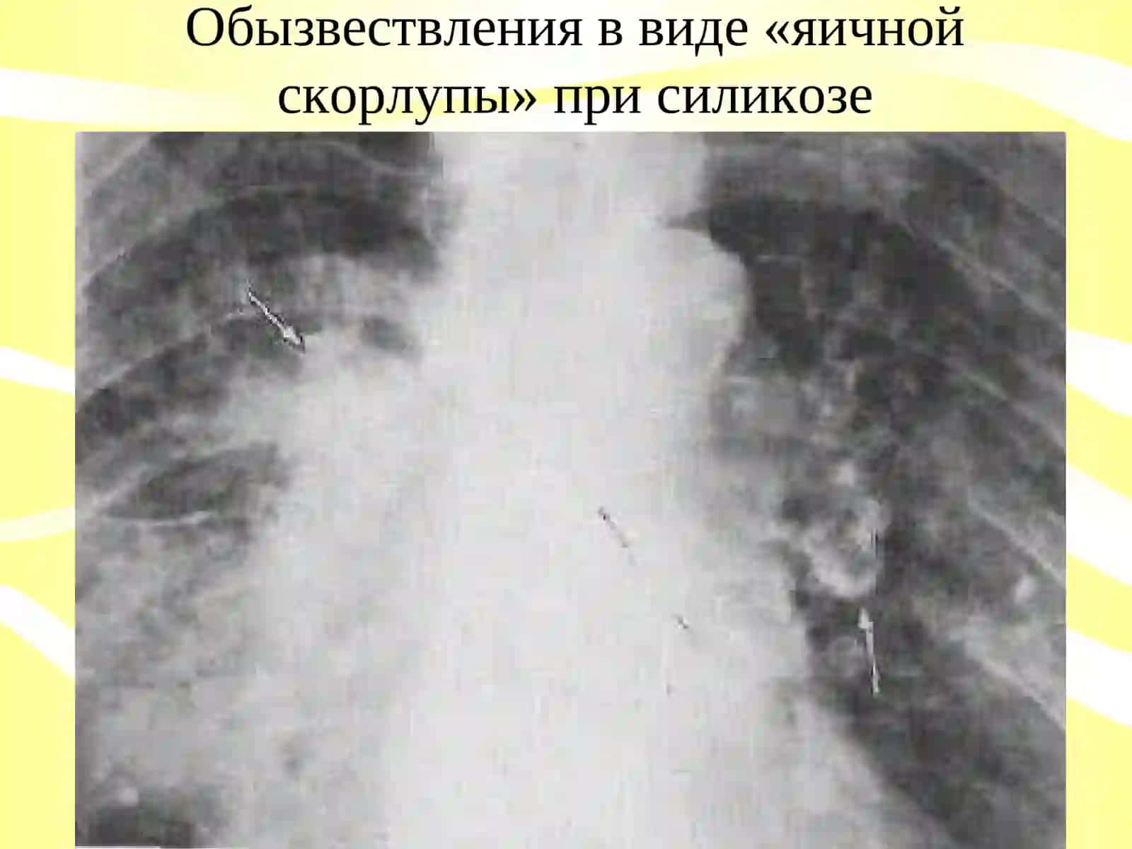 Кальцинаты грудной клетки 3