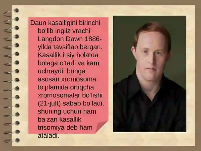 Daun sindromi 3