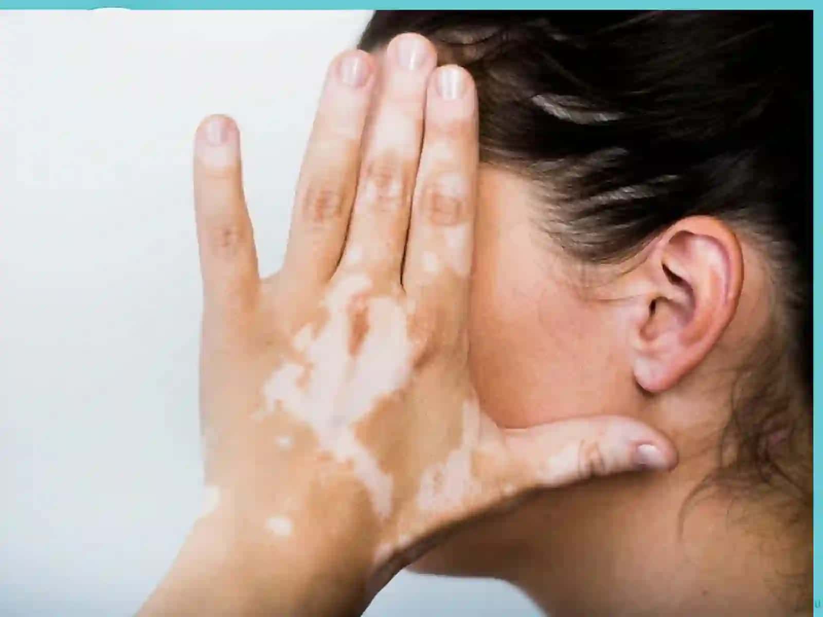 VITILIGO HAQIDA 3