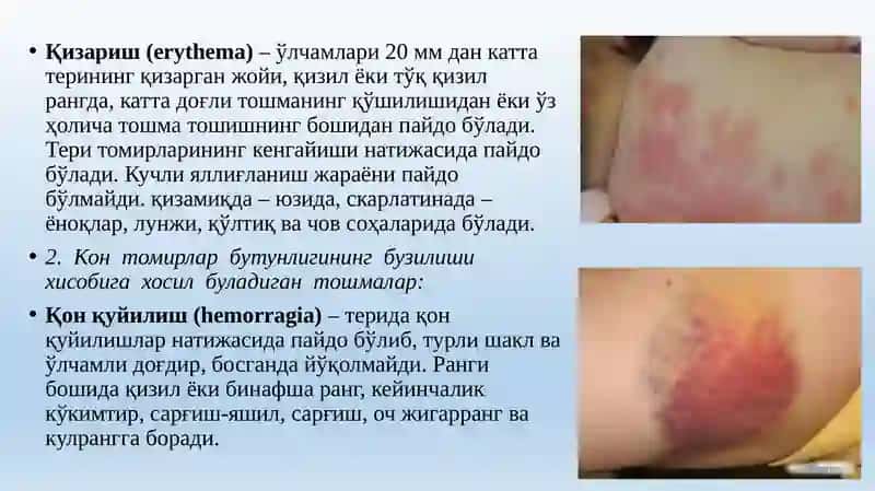 Ekzema bilan kechuvchi kasalliklar 3