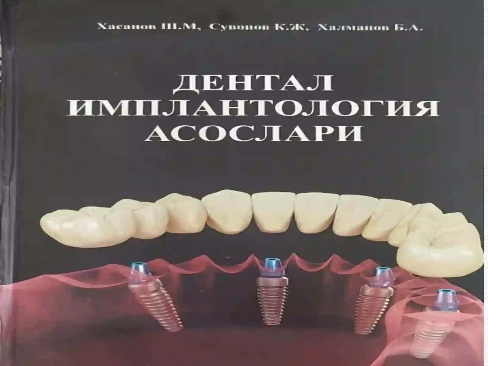 Дентал имплантация тарихи, ишлатадиган материаллар ва уларнинг таснифи. Дентал имплантацияга курсатма ва карши курсатмалар. Жаглардаги альвеоляр усигни атрофияси,таснифи. Жаглар альвеоляр усиги калинлиги ва баландлигини тиклаш уссуллари 3