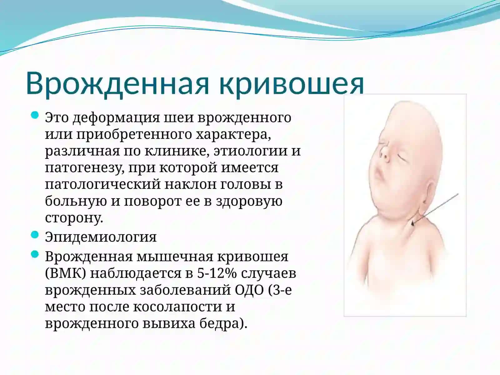 Врожденная мышечная кривошея 3