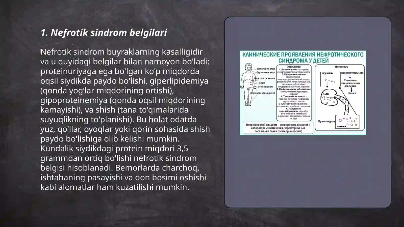 Nefrotik sindrom 3