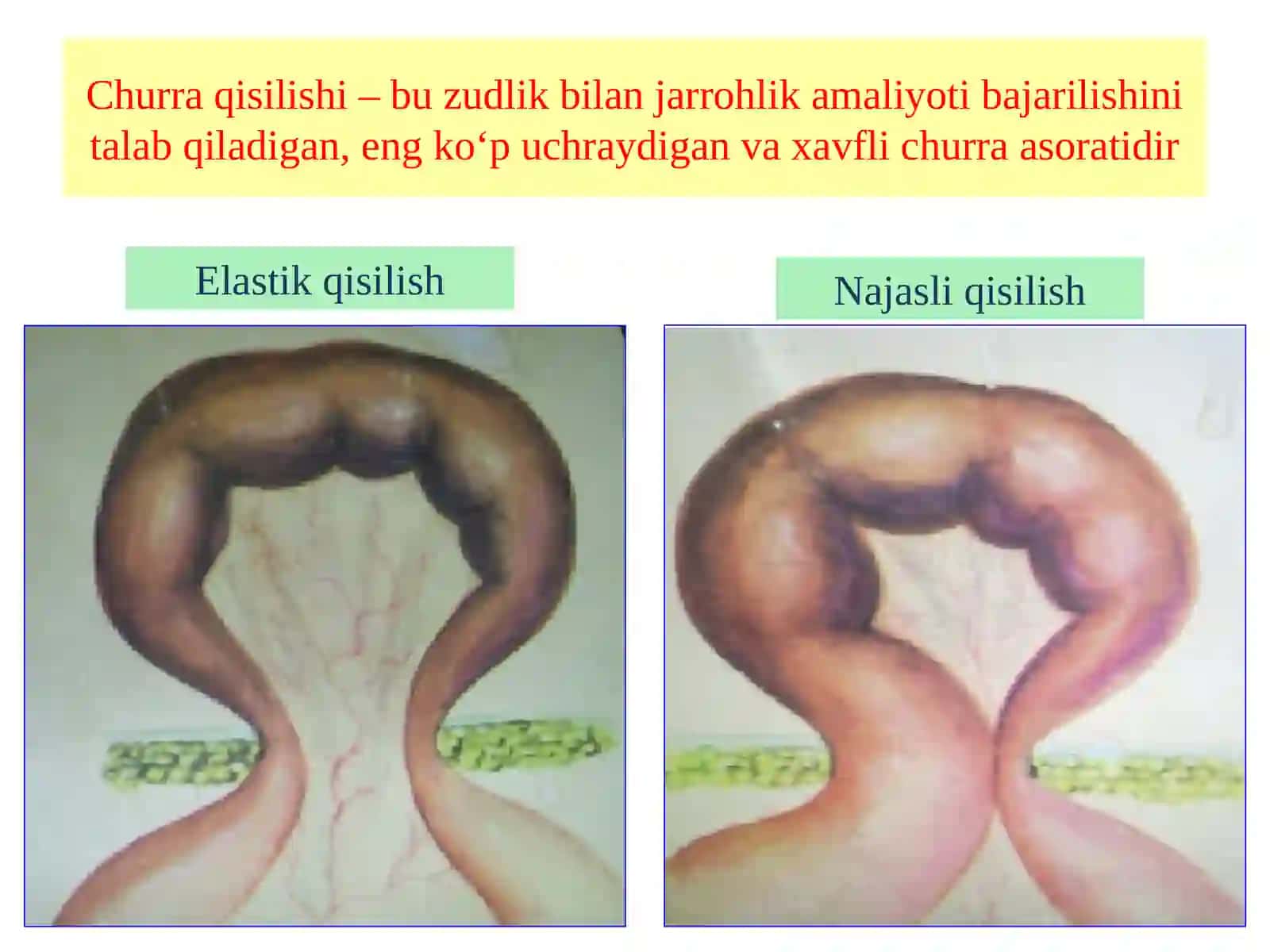 Qorin churralarining asoratlari 3