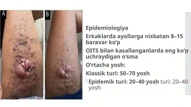 Kaposhining sarkomasi. Ekzema Kaposhi.IFAva PZR diagnostik usullarining dermatovenerologiyada qoʻlla 3
