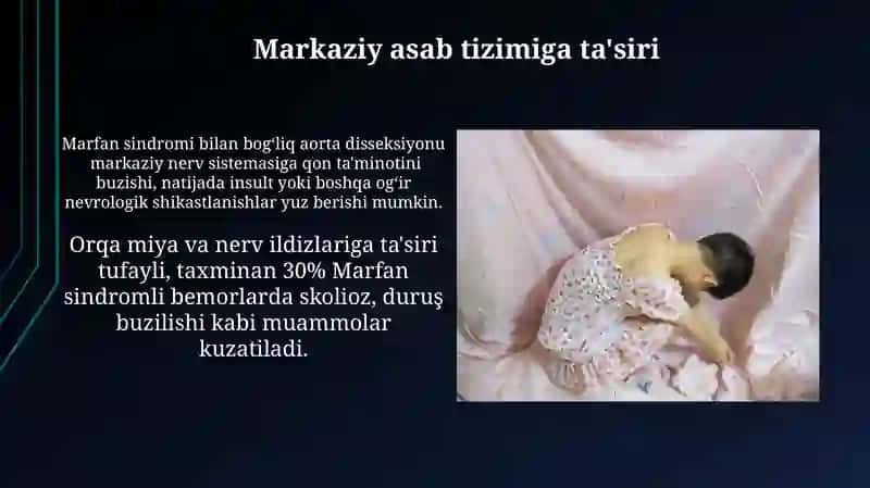Marfan Sindromi 3