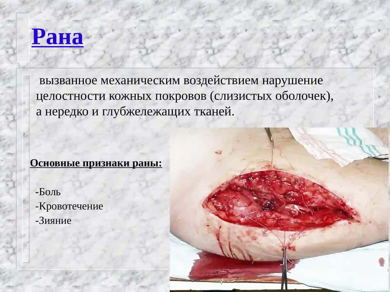 Рана 3