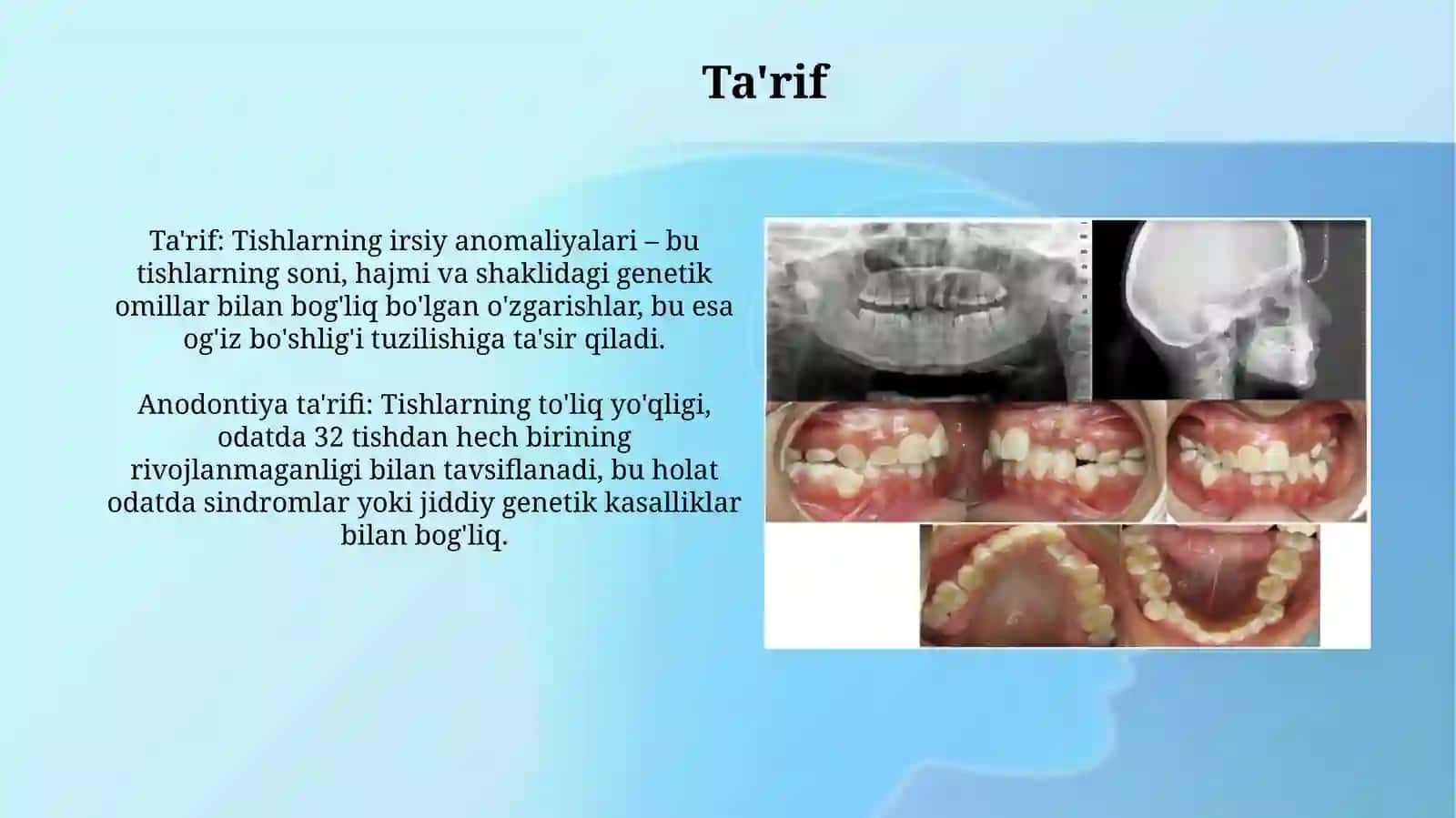 Tishlarning irsiy anomaliyalari (anodontiya, gipodontiya, makrodontiya, mikrodontiya) 3