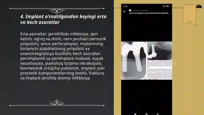 Implant quyilgandan keyingi asoratlar va periimplantit kasallik kelib chiqishi 3
