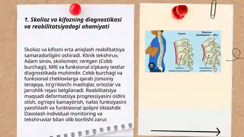 Tayanch harakat apparati kassalliklarida reabilitatsiya usullari.Skalioz va Kifoz 3