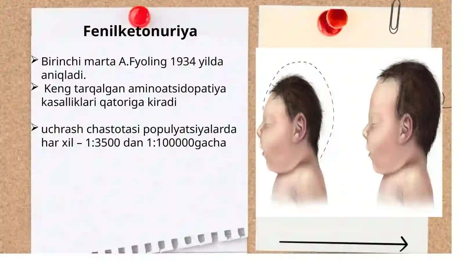 Terining (dermatozlar) nasliy kasalliklari, Qandsiz diabet kasalligi 3