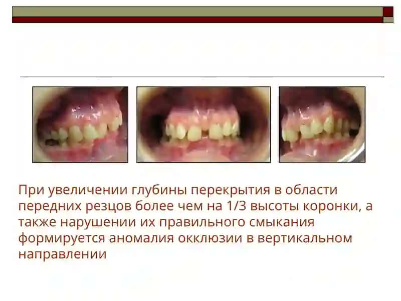 Глубокий прикус 3