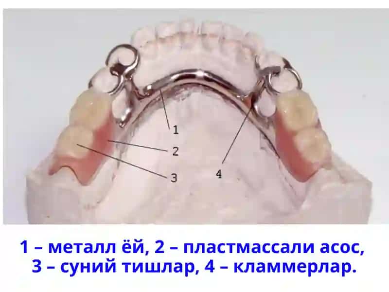 Бюгель протезларга курсатмалар, таркибий қисмлари 3