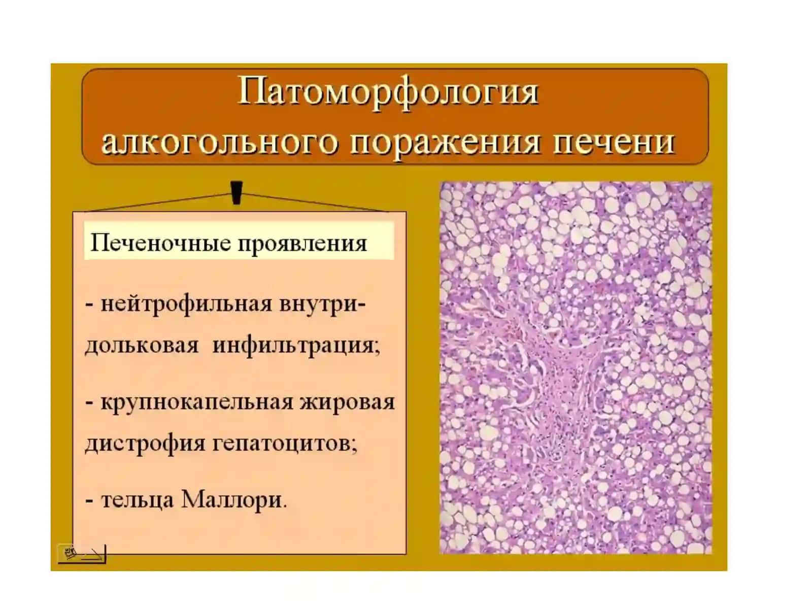 Патологическая анатомия печени 3