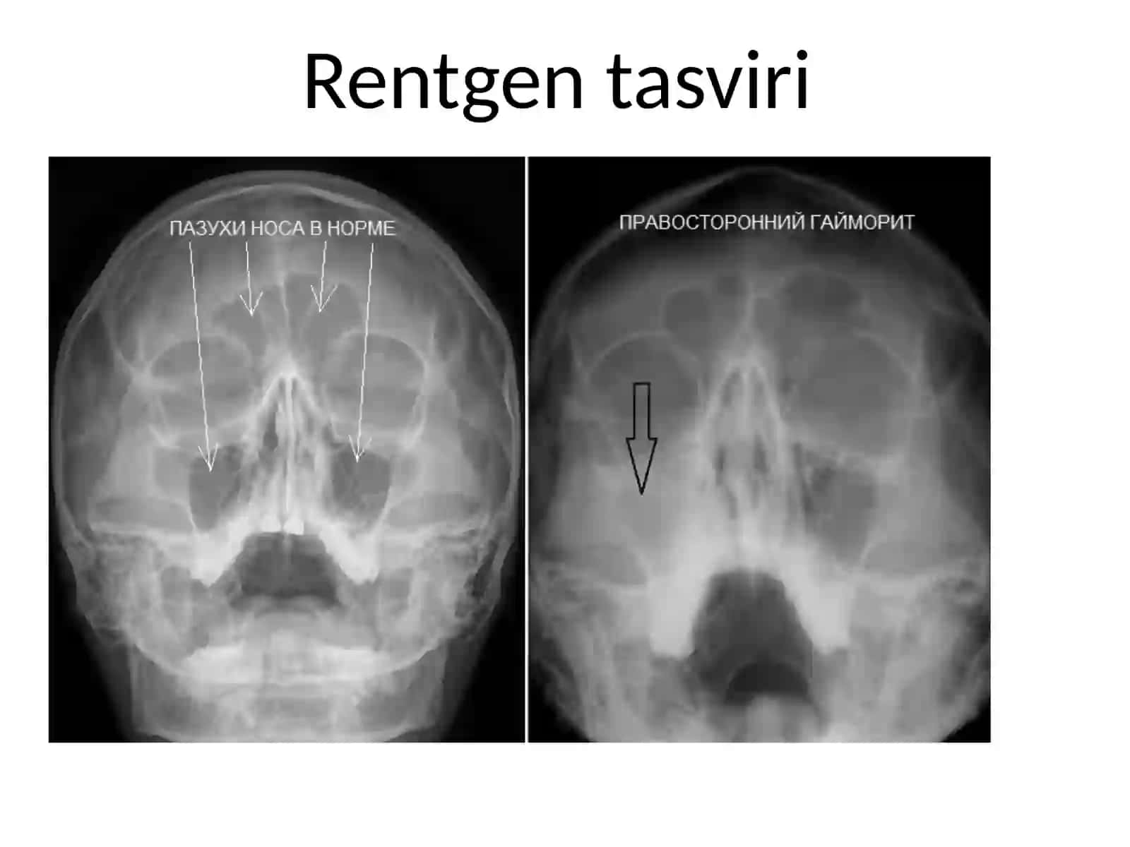 Burun va yondosh bo'shliqlarni 3D rentgeni Конусно-лучевая компьютерная томография (КЛКТ) 3