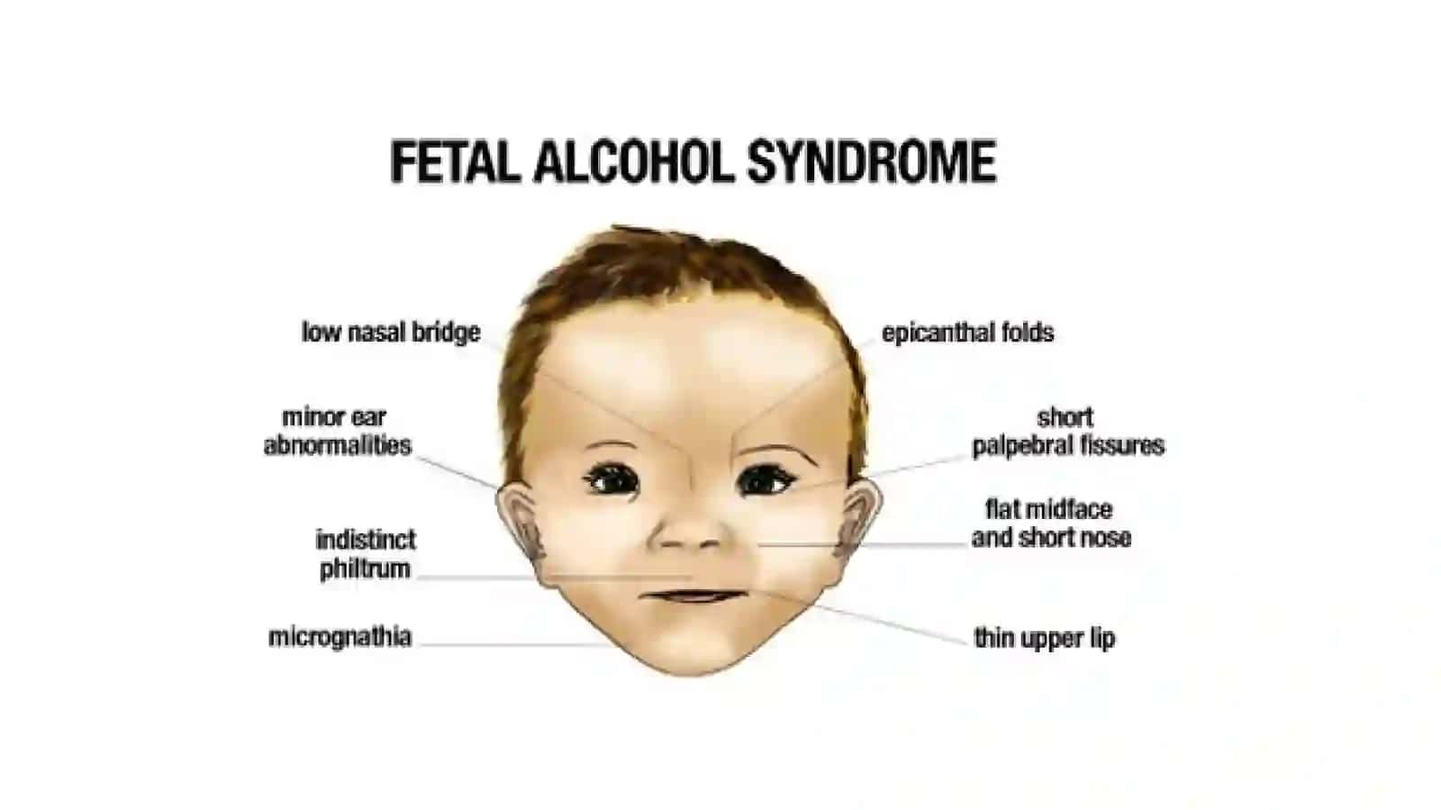 Yangi tug'ilgan chaqaloqda alkogol sindromi. Narkomanlar bolalari 3