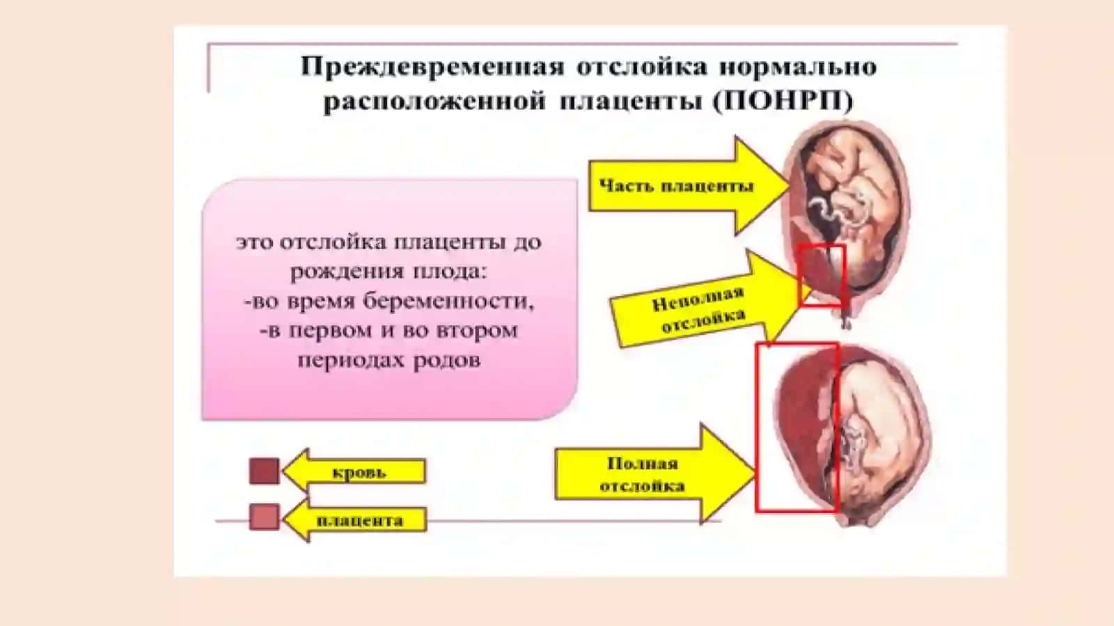 Ведение беременных с кровотечениями в сроке беременности после 22 недель 3