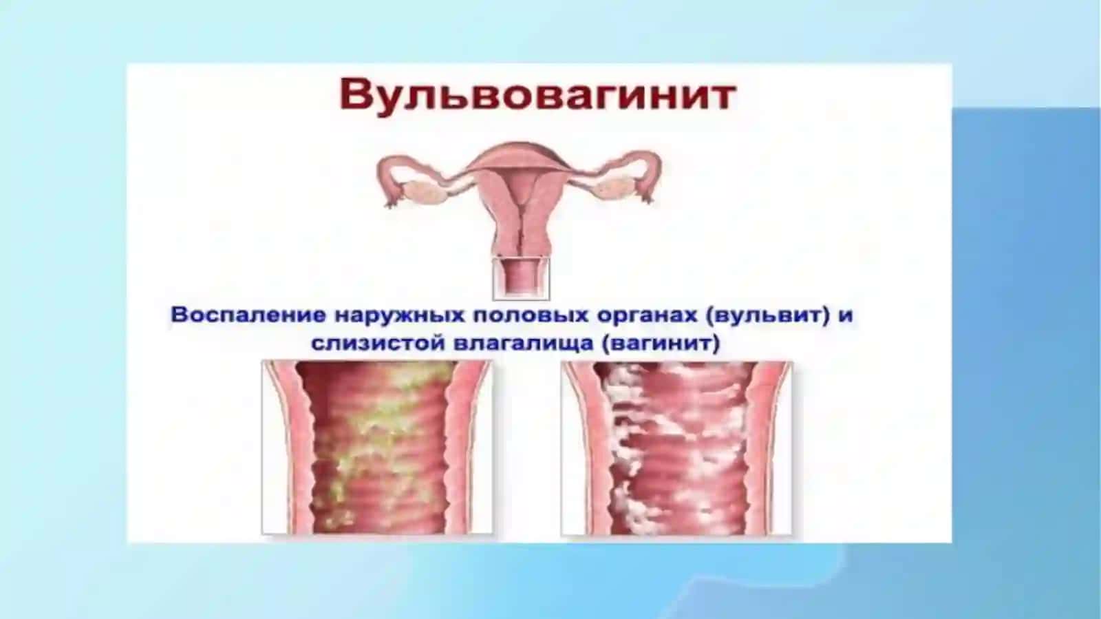 ayollar  jinsiy a'zolari nospesifik etiologiyali yalligʻlanish kasalliklari 3