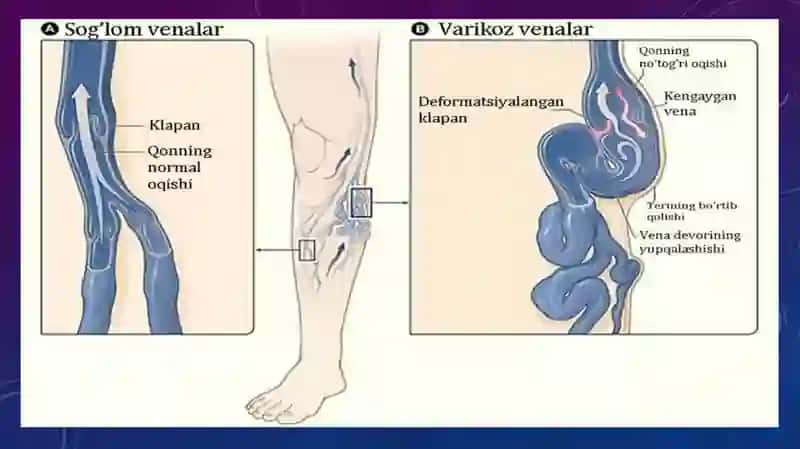Oyoq venalarining varikoz kasalligida bajariladigan operatsiyalar. 3