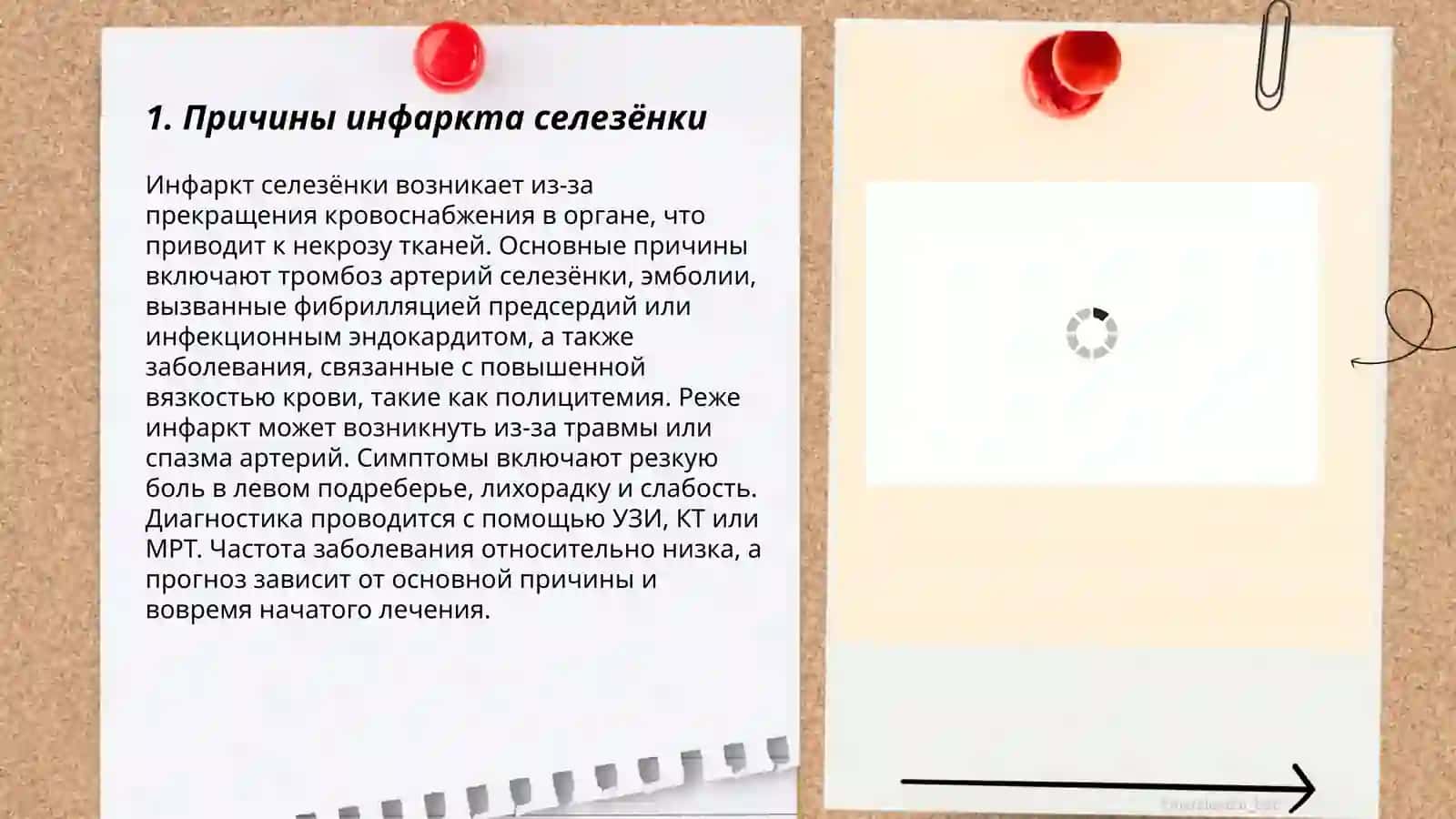 Инфаркт селезёнки 3