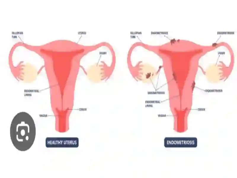 Endometrioz-bachadonshilliq 3