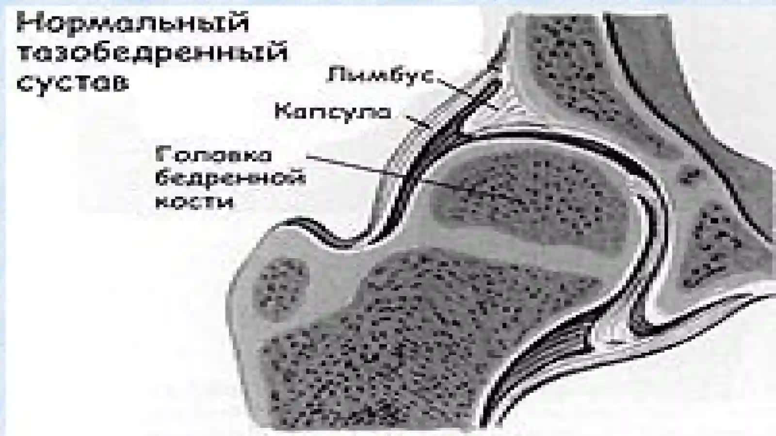 Чаноқ-сон бўғими дисплазияси 3