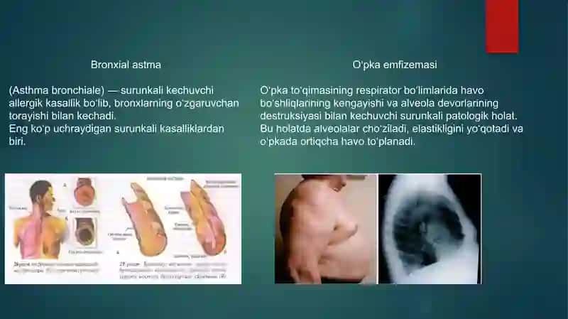 O‘pka to‘qimasida havo ortib ketish sindromi XOBL infeksiyalar.  Bronxial astma. Oʻpka emfizemasi 3