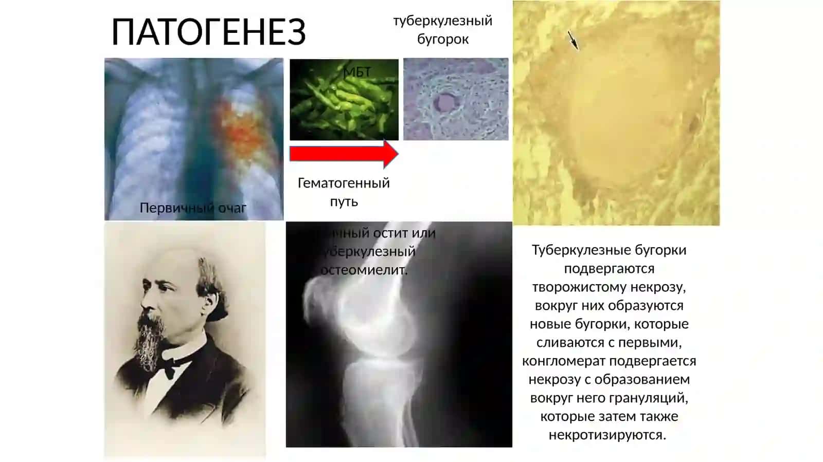 Хирургический туберкулёз 3
