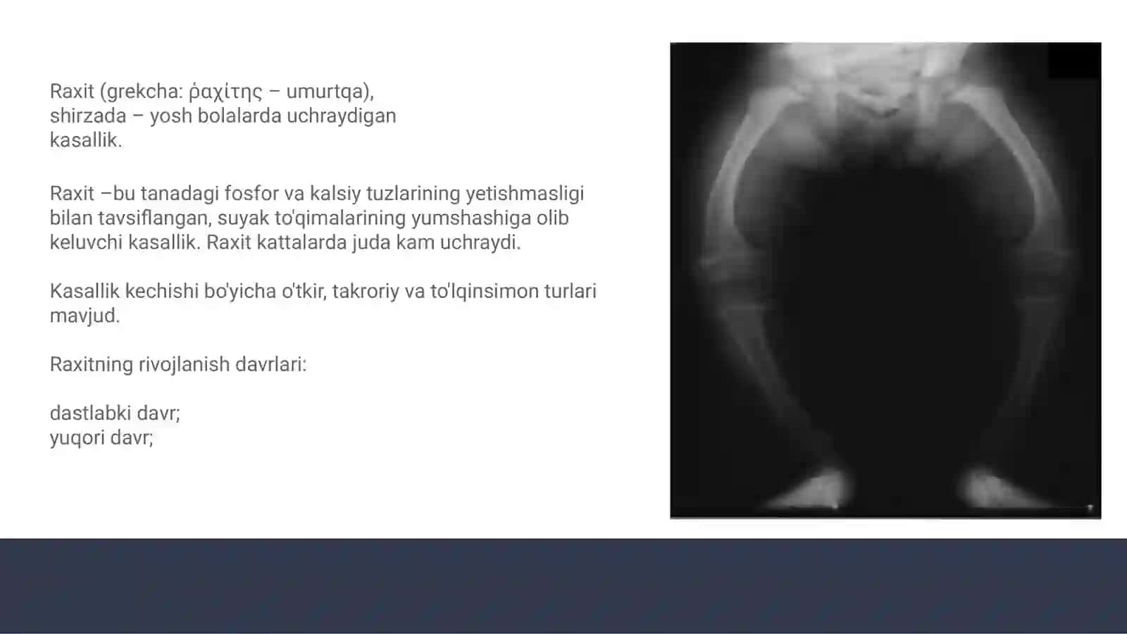 Raxit kasalligi 3