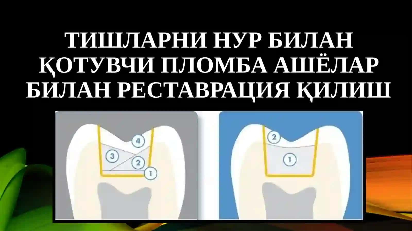 Тишларни нур билан қотувчи пломба ашёлар билан реставрация қилиш 3