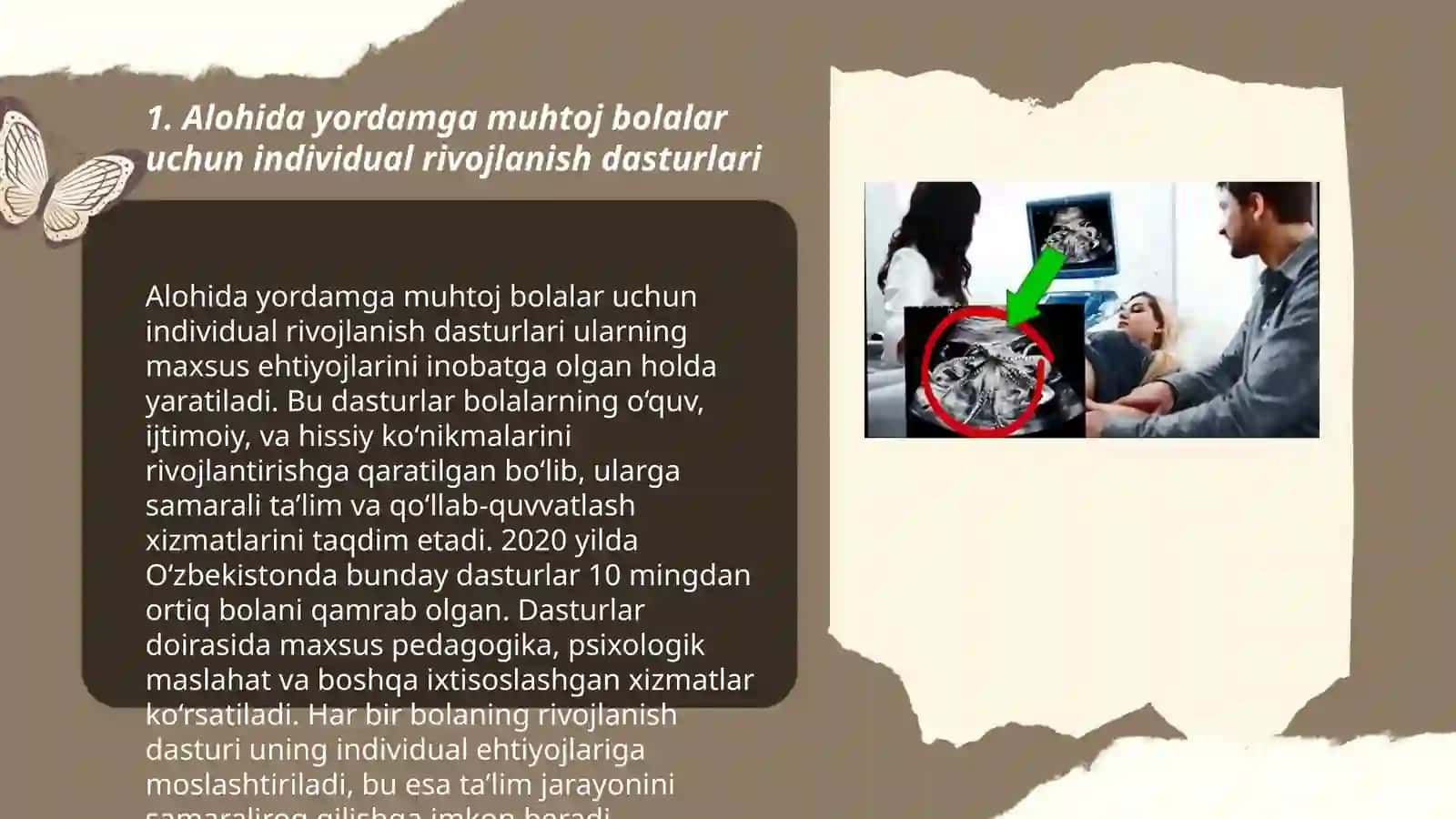 Alohida yordamga muhtoj bolalarda rivojlanishdagi nuqsonining chuqurligi va tuzilishiga qarab inlyuziya modellarini tanlash 3