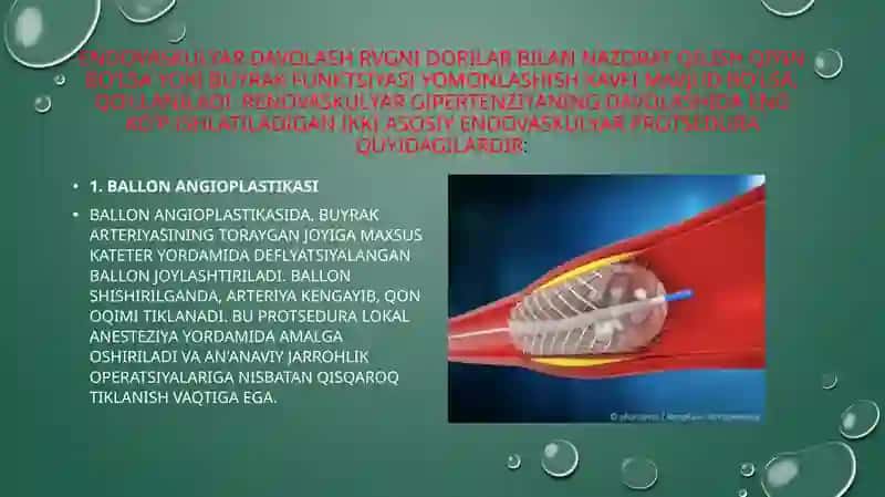Renovaskulyar gipertenziyani endovaskulyar davolash 3