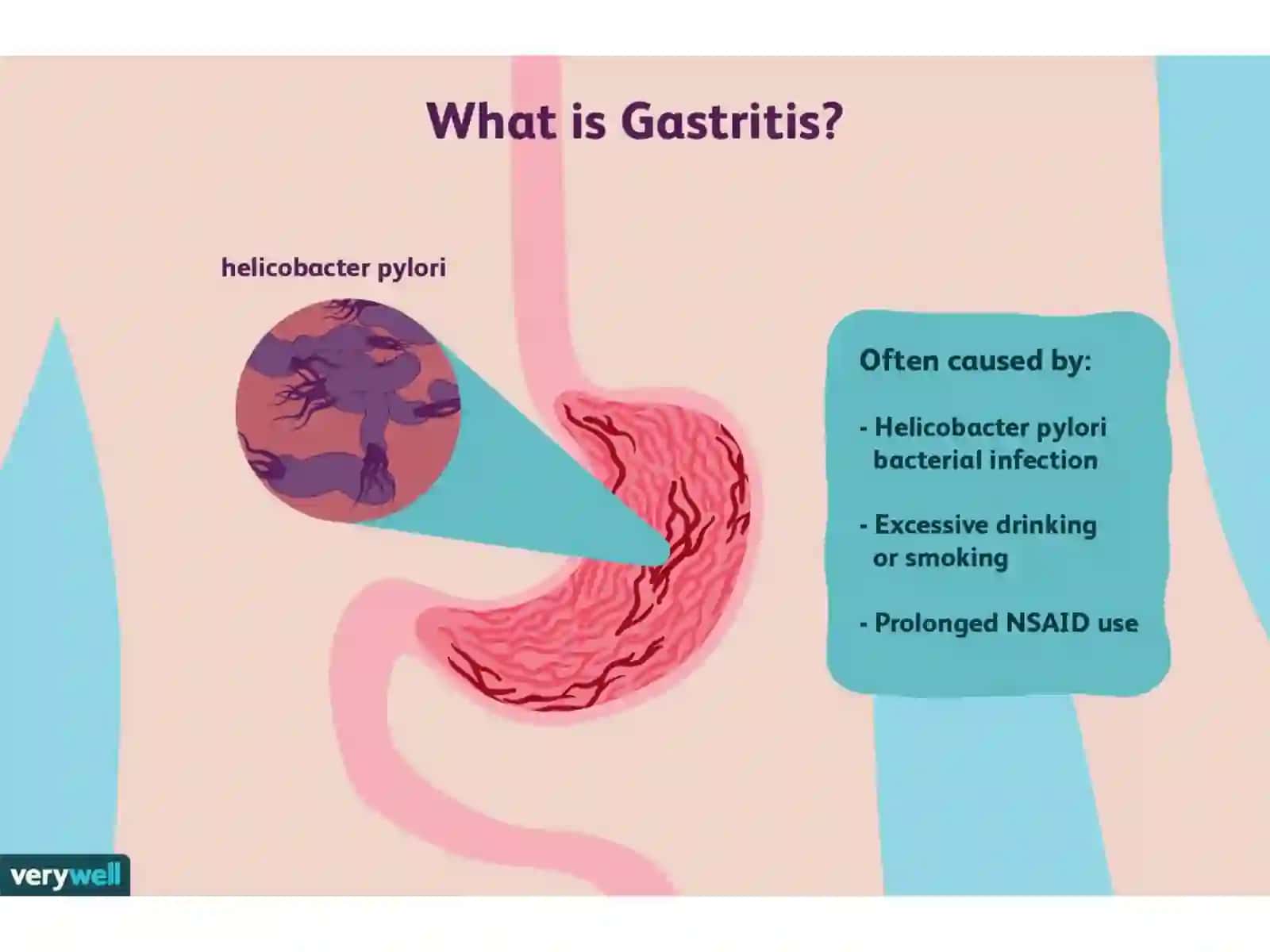 Gastritlar: turlari, etiologiyasi, patogenezi va davolash usullari 3