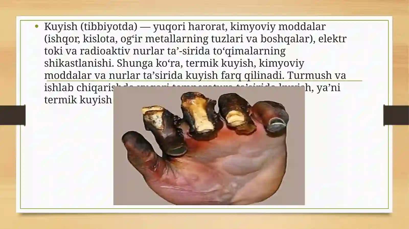 Kuyish kasalligi 3