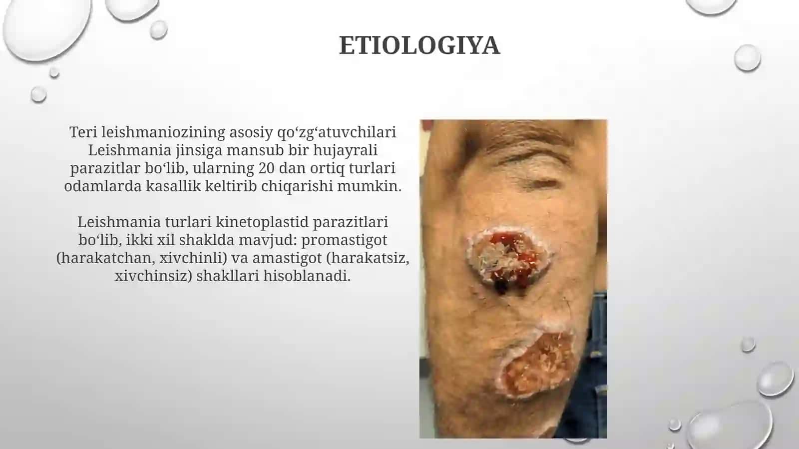 Leymanioz teri shakli etiologiyasi, epidemiologiyasi, klinikasi va davolash 3