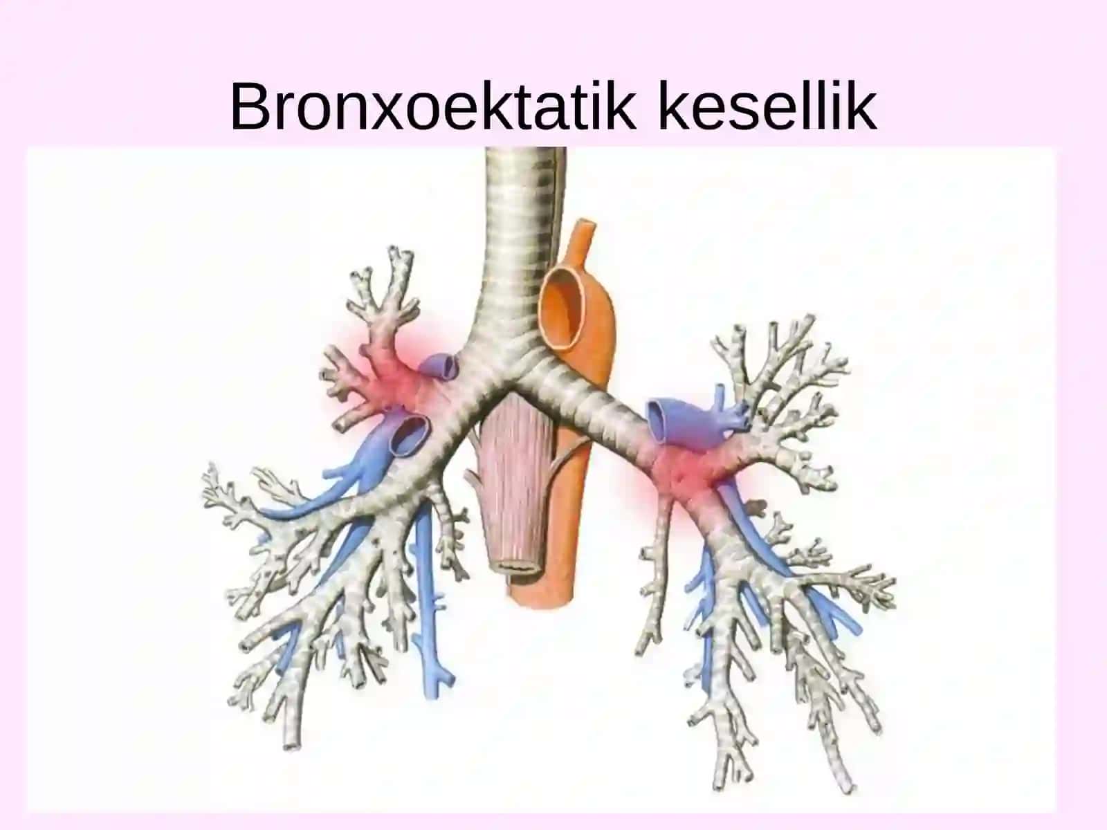 Bronxoektatik Kesellik Diagnostikasi 3