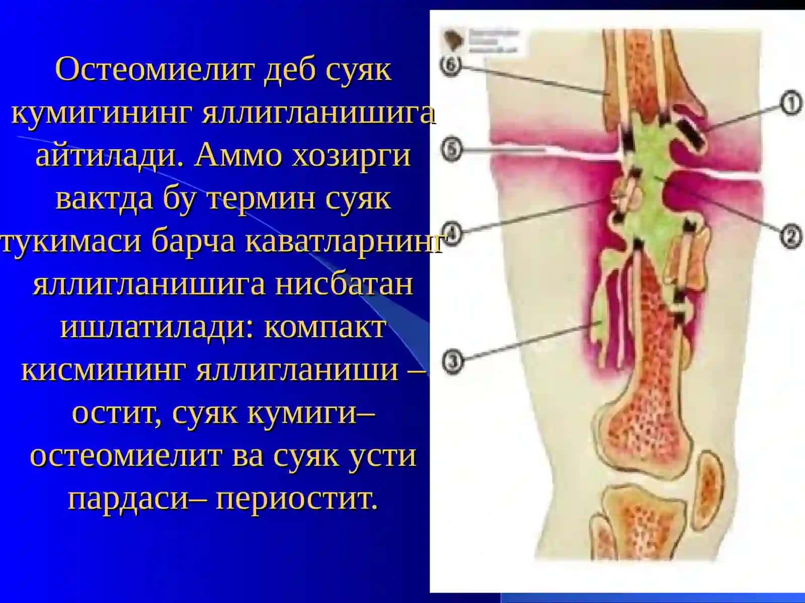 «Остеомиелит, артрит, бурсит» 3