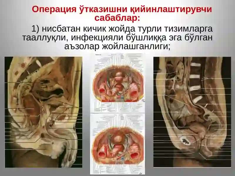 Тос соҳаси топографик  анатомияси. Тос бўшлиғи аъзоларидаги асосий операциялар. 3