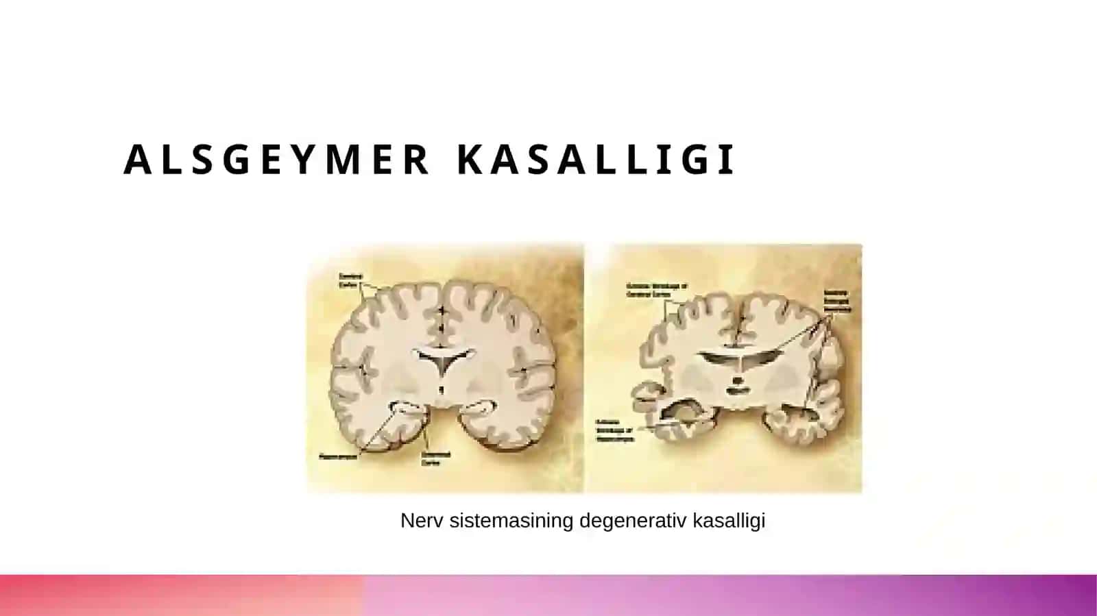 nerv sistemasining degenerativ kasalliklari 3