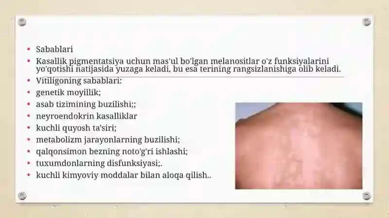 VITILIGO VA UNING TASNIFI PATOGENEZI KLINIKASI VA DAVOLASH 3