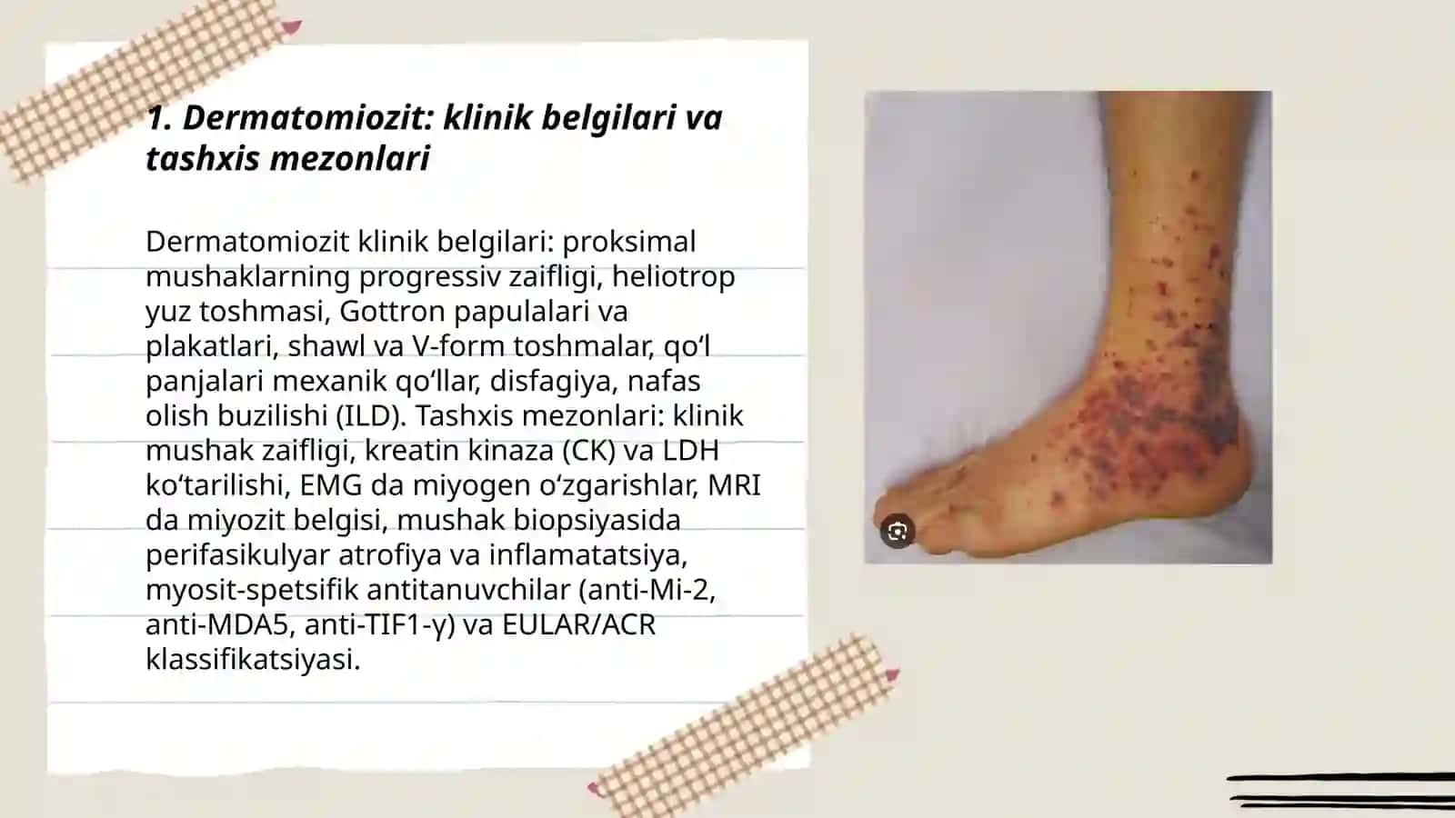 Dermatomiozit va tizimli vaskulitlarning diagnostika me‘zonlari, aktivlik darajalari, davolash usullari 3