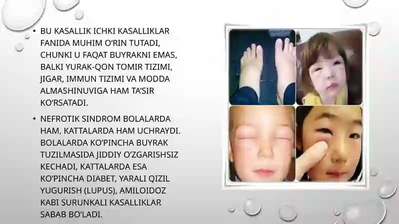 Nefrotik sindrom 3